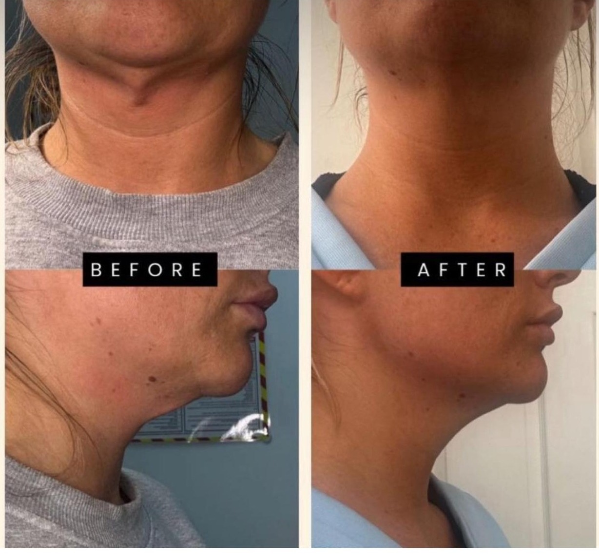 Neck Tightening — 6 Weeks Post-Treatment