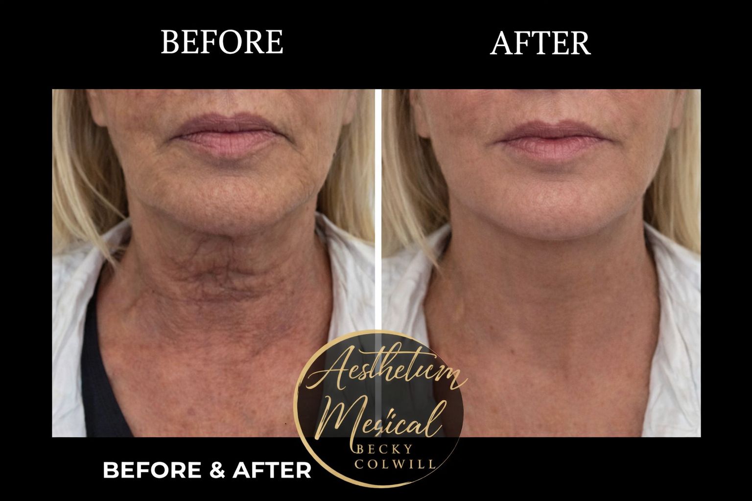 Neck & Jowls Tightening