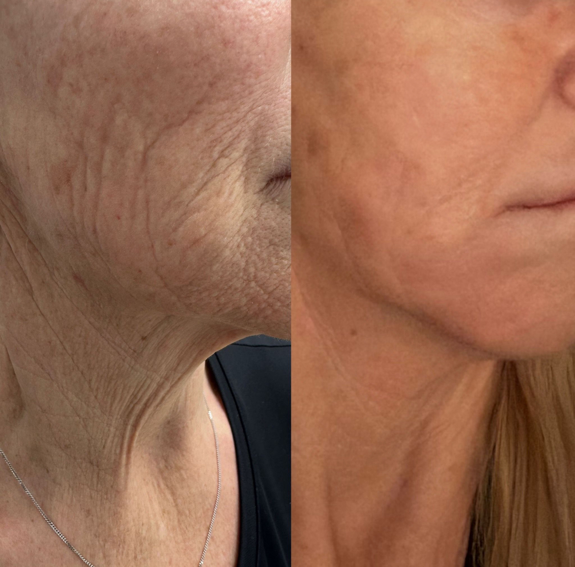 Neck Skin Rejuvenation